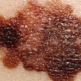 Dermatološkinja poručuje - čuvajmo kožu jer drugu nemamo 7
