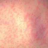 U epidemiji malih boginja u Zimbabveu umrlo 157 dece 7