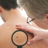 Besplatni pregledi za prevenciju raka kože 14