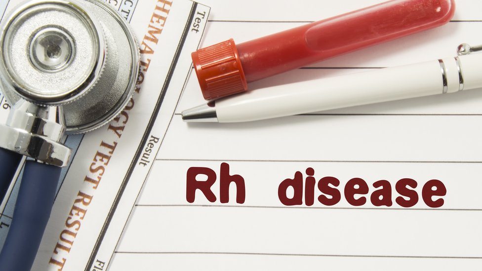 Džejms Harison ide u penziju nakon što je spasio 2,4 miliona beba 2 Hemolitička bolest