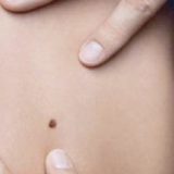 Kampanja "Euromelanoma dan" podseća da Srbija ima problem sa rakom kože 6