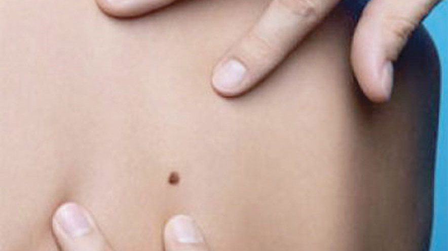 Kampanja "Euromelanoma dan" podseća da Srbija ima problem sa rakom kože 1