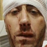 Pretučeni novinar BN TV zabrinut za porodicu 9