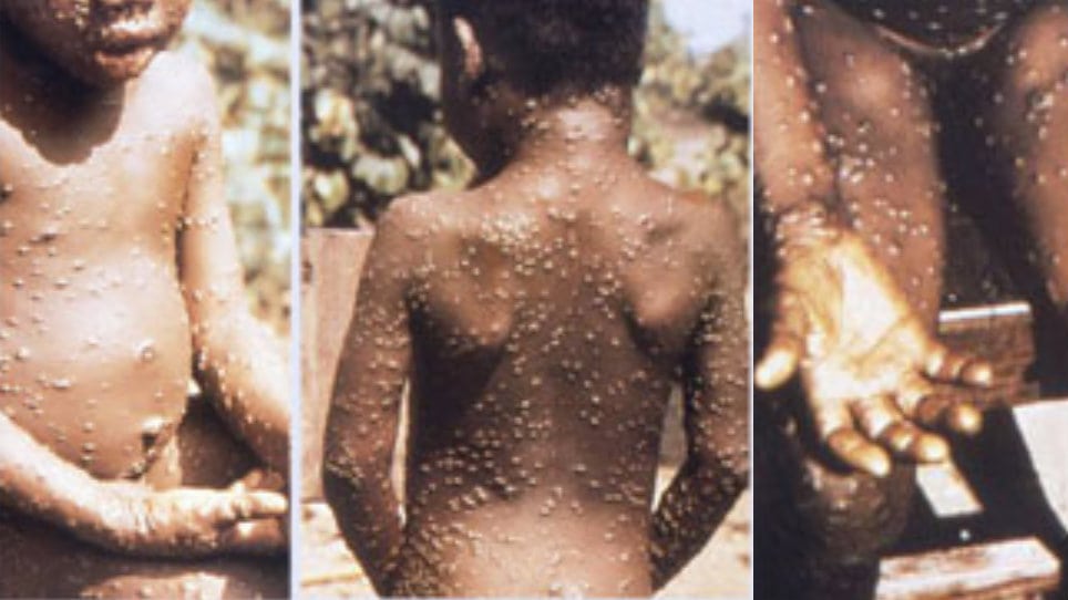 Ne očekuje se epidemija majmunskih boginja u Evropi 1