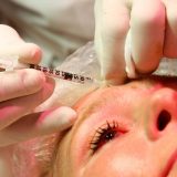 Odgovori doktora na najčešća pitanja o botoksu 4