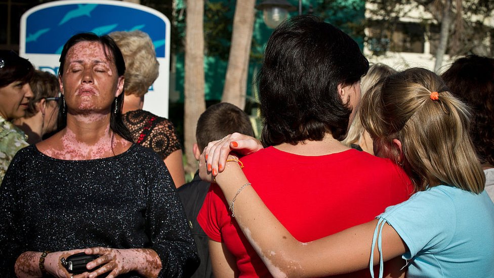 Women with vitiligo in Cuba