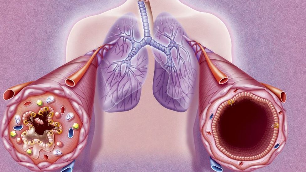 The bronchial tubes during an asthma attack and in a normal state