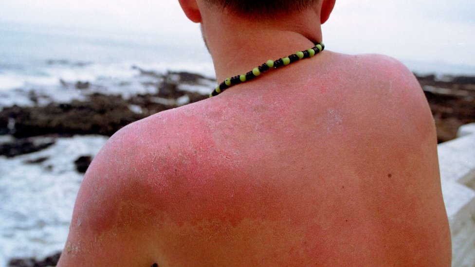 A man suffering from sunburn in Brazil.