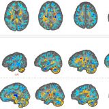 Potvrđene promene na mozgu diplomata SAD koji su bile na Kubi 10