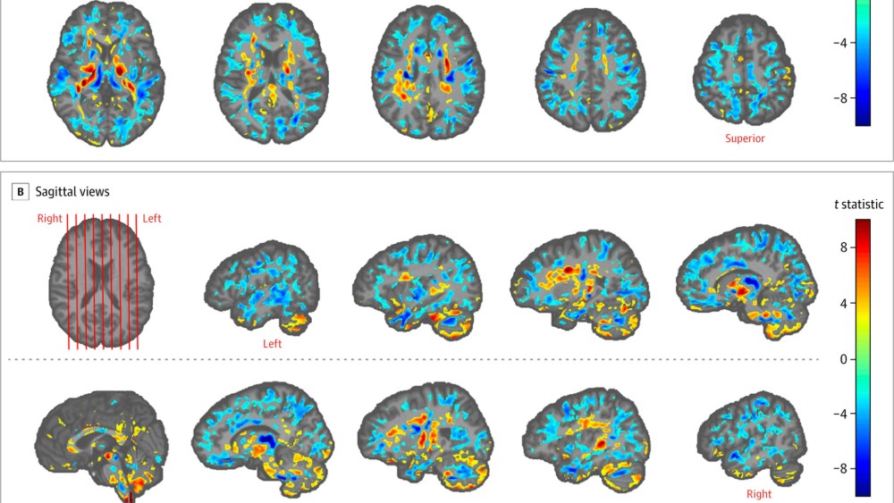 Potvrđene promene na mozgu diplomata SAD koji su bile na Kubi 1