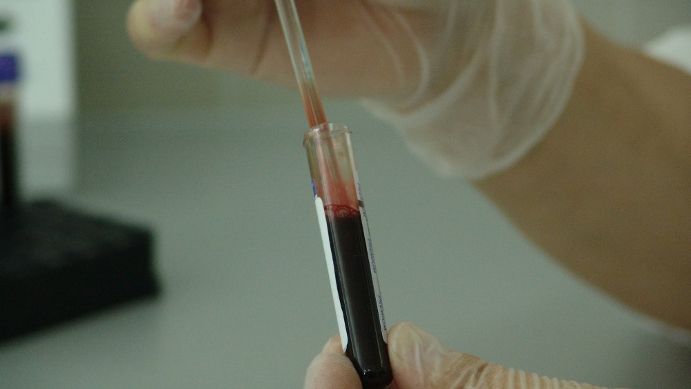 Zaposlenima u KC Kragujevac tri puta vađena krv, iako je taj test nepouzdan za korona virus 1