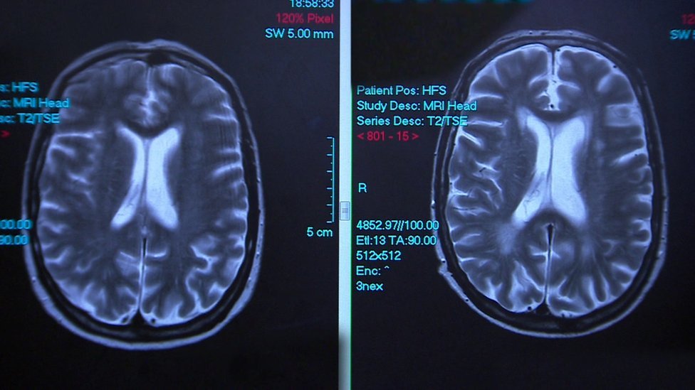 Kad alkohol ošteti mozak: I zdravstveni problemi i osude 1 Brain scans of the same person, eight years apart, the enlarged white areas on later scan on the right are alcohol damage