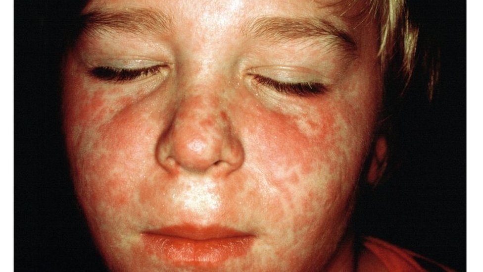 boy with measles