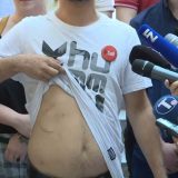 Marković pokazao modrice kao pozdrav od Vučića 13