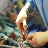 Istorijski podvig srpskih kardiohirurga – pacijentu ugrađena dva veštačka srca 4