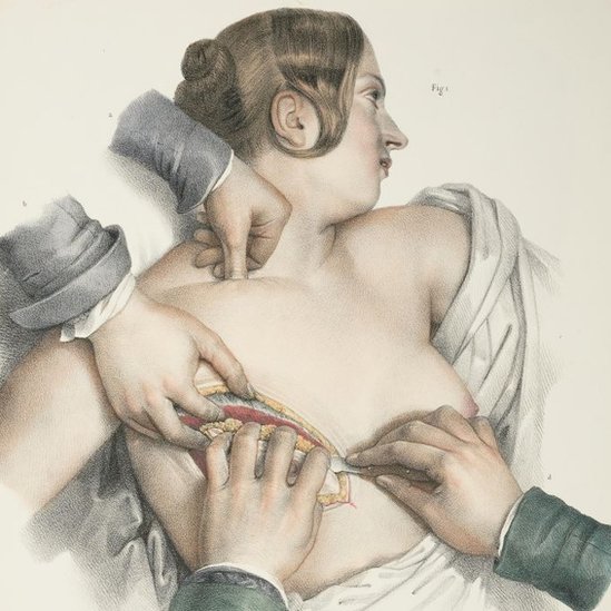 An illustration showing a mastectomy procedure, circa 1900