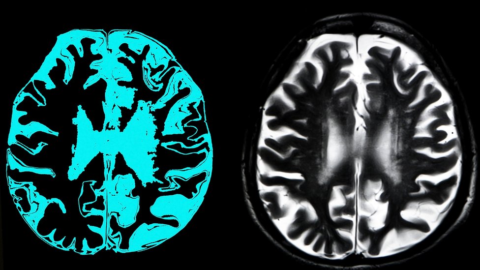 Negovatelji dementnih ukućana u Srbiji: Nevidljivi za sistem, neophodni za život 5 Brain scan