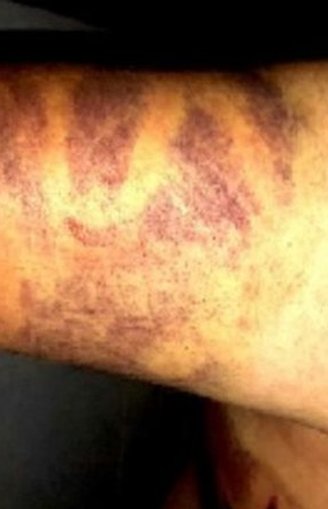 Shadi was tortured by Turkish-backed factions in Afrin by burning his body with an an iron skewer