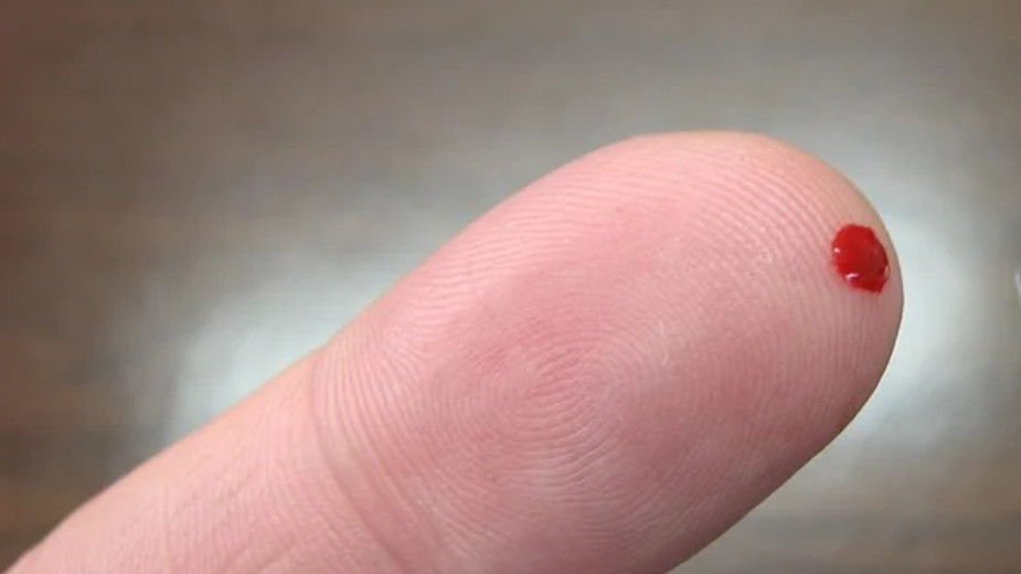 Svetski dan osoba sa hemofilijom, u Srbiji 900 obolelih 1