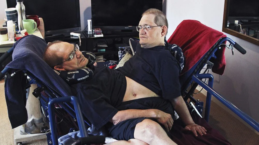 Sijamski blizanci s najdužim životnim vekom umrli u 69. godini 1