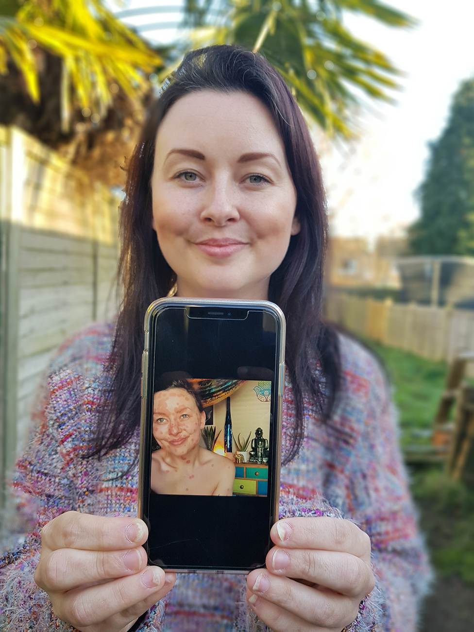 Aimee shows a picture of her psoriasis
