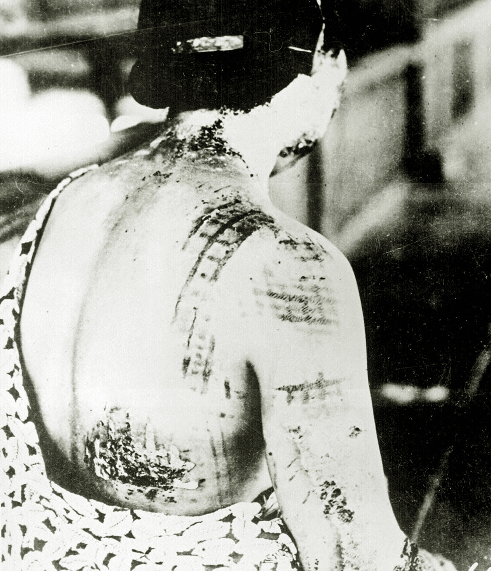 A woman shows burns on her neck, shoulders and back