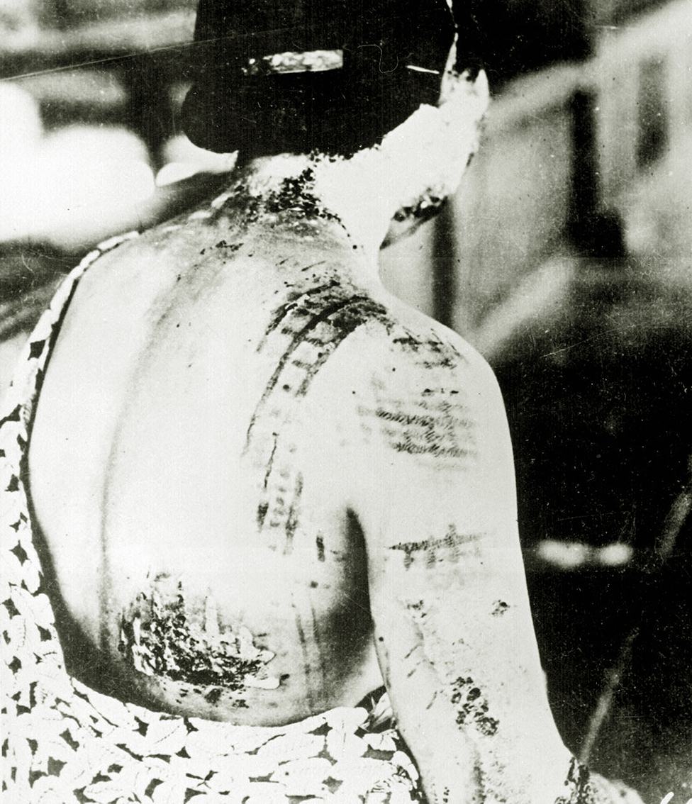 Hirošima i Nagasaki: 75 godina od atomske bombe 6 A woman shows burns on her neck, shoulders and back