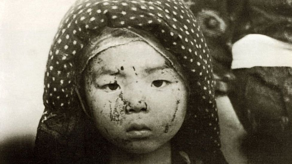 A child survivor of the Nagasaki bombing with facial injuries
