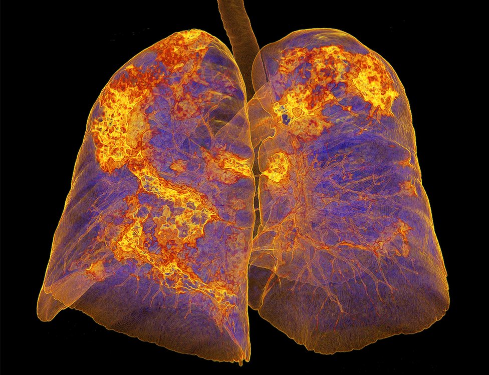 Lungs infected with coronavirus