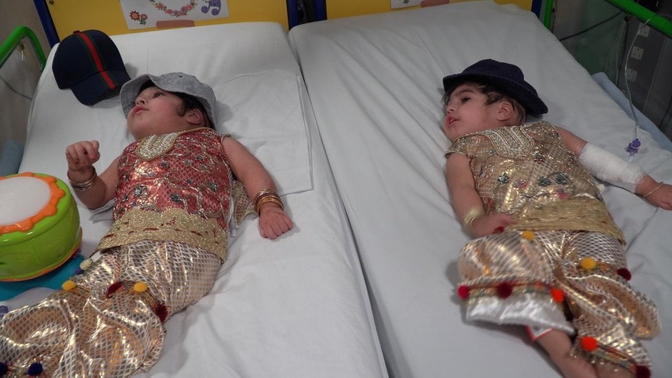 Safa and Marwa following recovery after the operation to separate them