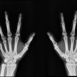 Svetski dan borbe protiv osteoporoze 10