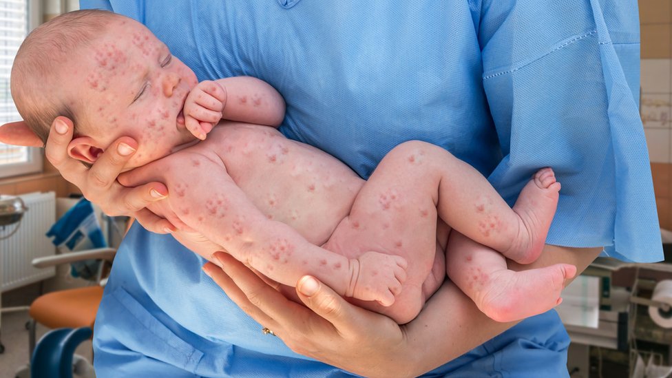 Vakcine, zdravlje i Srbija: Novi propisi o obaveznoj i preporučenoj vakcinaciji 2 Baby with measles