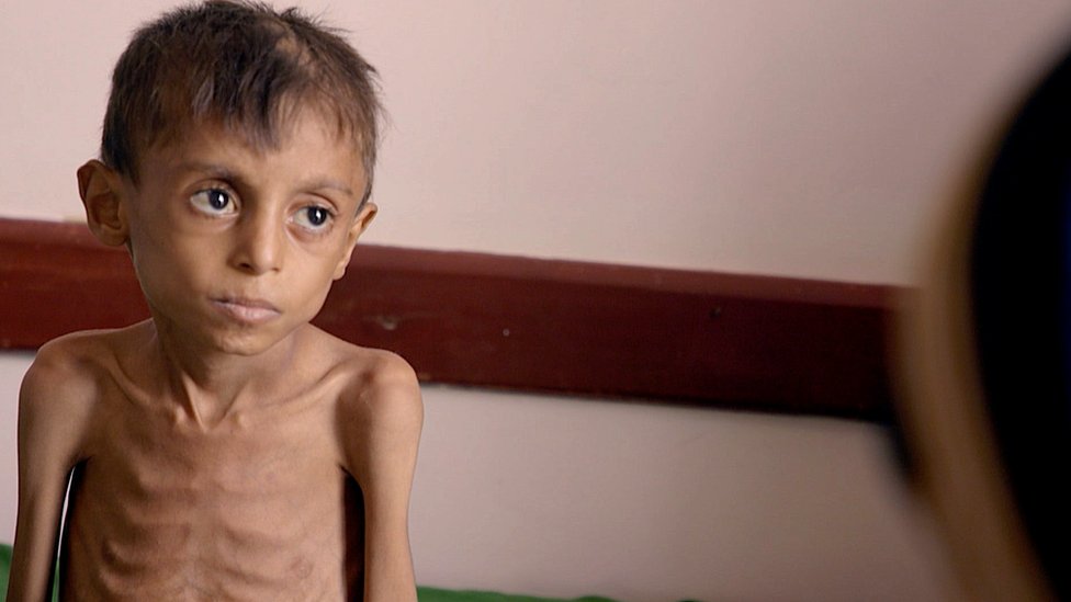 A severely malnourished child in Yemen