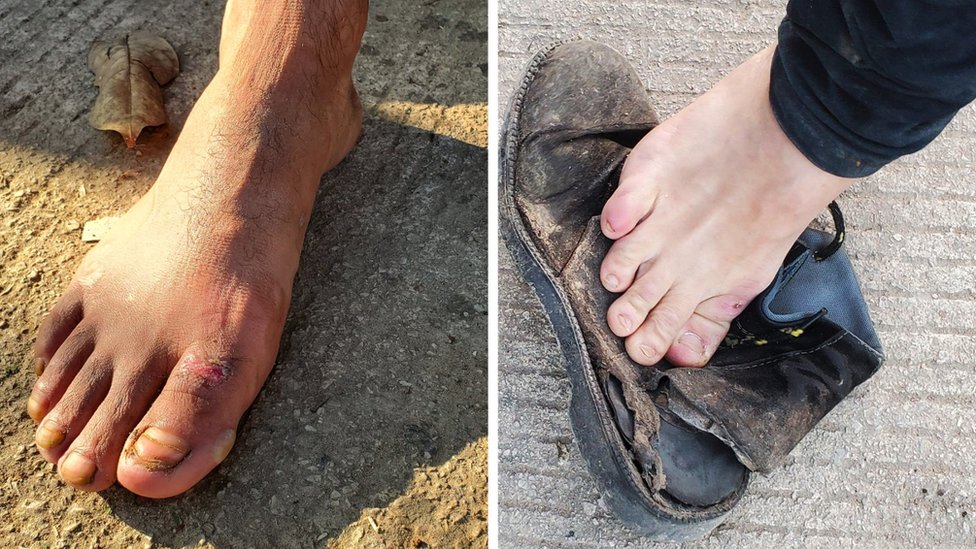 Migrants feet with cuts and bruises on