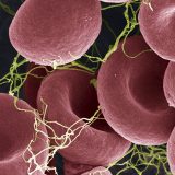 Korona virus i vakcine: AstraZeneka i krvni ugrušci - sve što treba da znate 7