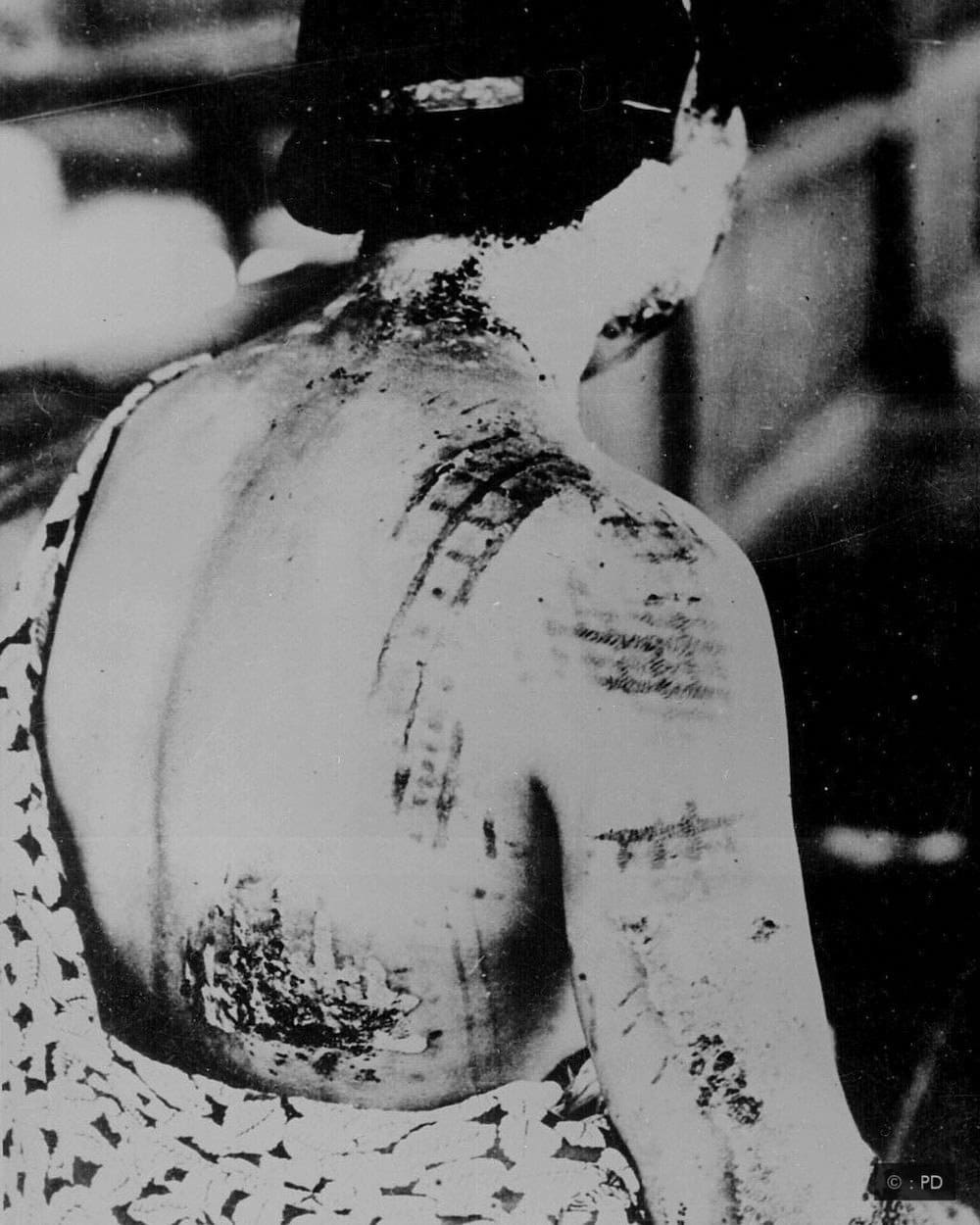 Hirošima i Nagasaki: Može li nuklearni rat biti moralno opravdan 5 povrede posle nuklearne bombe