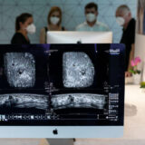 Broj mamografskih pregleda u nekim zemljama Evrope opao za 90 odsto tokom pandemije 5