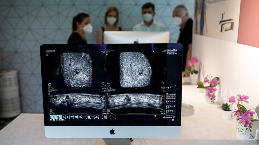 Broj mamografskih pregleda u nekim zemljama Evrope opao za 90 odsto tokom pandemije 1