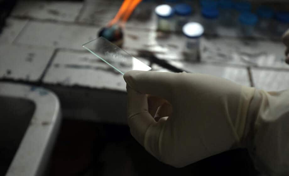 Broj umrlih od tuberkuloze prvi put raste u poslednjih deset godina 1