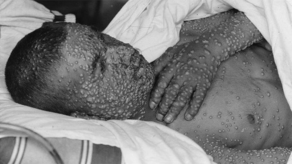 Korona virus i vakcina: Kako su antivakcinaši vršili uticaj na svet kroz istoriju 2 A smallpox patient covered with pustules