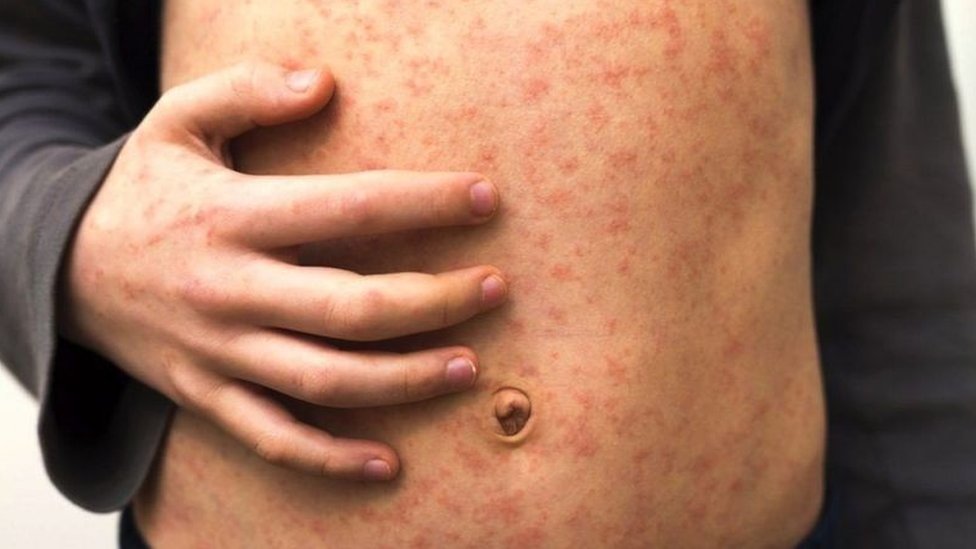 Korona virus i vakcina: Kako su antivakcinaši vršili uticaj na svet kroz istoriju 35 measles