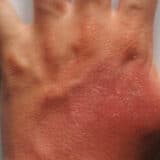 Opekotine u kući - problem koji se može sprečiti 10