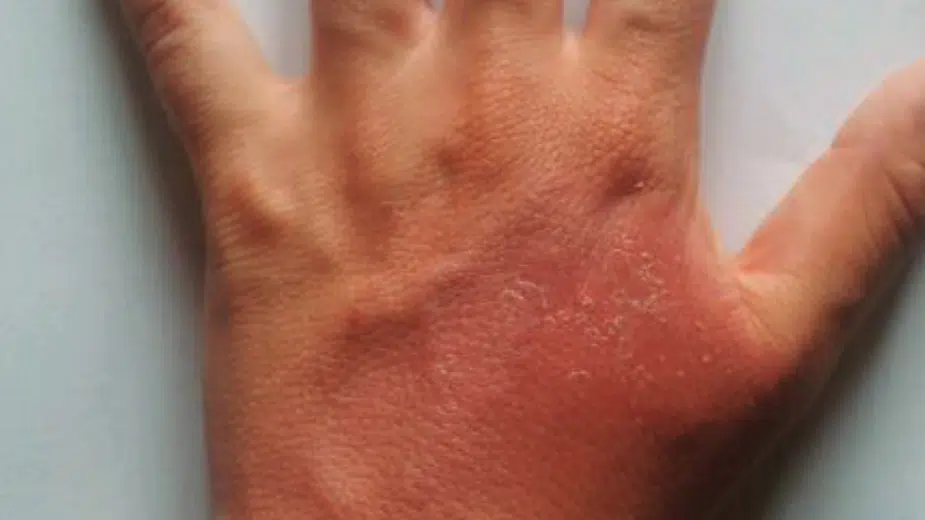 Opekotine u kući - problem koji se može sprečiti 1