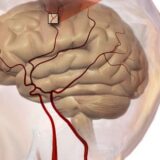 Tri "brza" okidača za opasni moždani udar 9