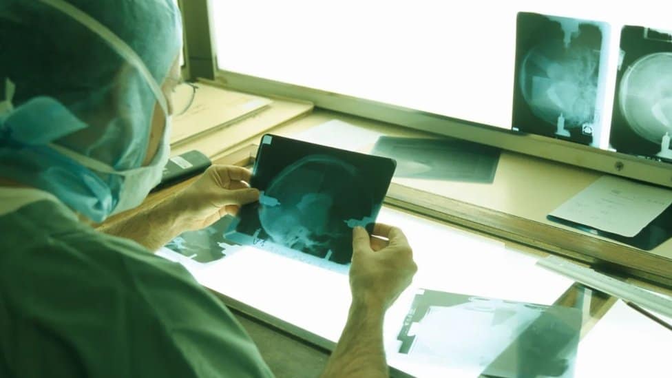 Korona virus: Da li su prethodne pandemije dovele do pojave Parkinsonove bolesti 3 Smatra se da određeni virusi mogu izazvati imuni odgovor koji kasnije povećava rizik da osoba razvije Parkinsonovu bolest