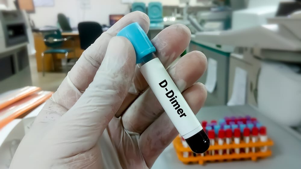 Šta pokazuju vrednosti D-dimera i da li je ovaj test neophodan u slučaju kovida? 1