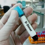 Šta pokazuju vrednosti D-dimera i da li je ovaj test neophodan u slučaju kovida? 4