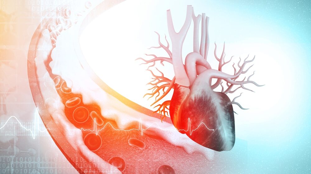 Najvažnije informacije o aterosklerozi koje treba da znate 1