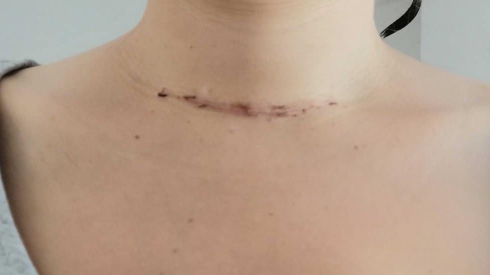 Kako smo se upoznale i zauvek rastale moja štitasta žlezda i ja 5 ožiljak