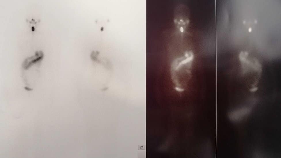 Kako smo se upoznale i zauvek rastale moja štitasta žlezda i ja 10 scintigrafija